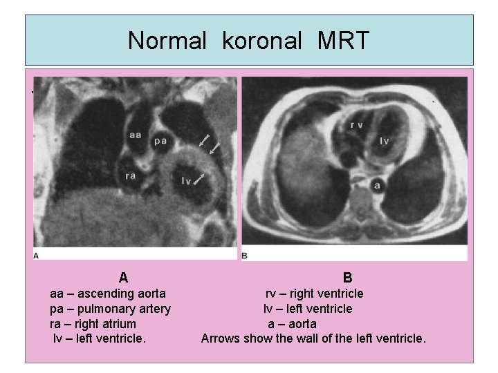 Normal koronal MRT. A aa – ascending aorta pa – pulmonary artery ra –