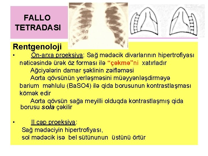 FALLO TETRADASI Rentgenoloji • Ön-arxa proeksiya: Sağ mədəcik divarlarının hipertrofiyası nəticəsində ürək öz forması