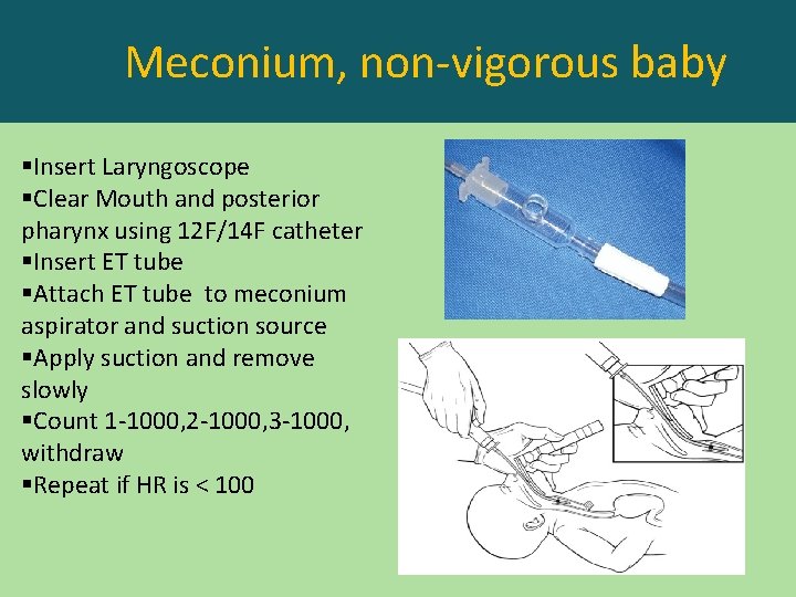 Meconium, non-vigorous baby §Insert Laryngoscope §Clear Mouth and posterior pharynx using 12 F/14 F