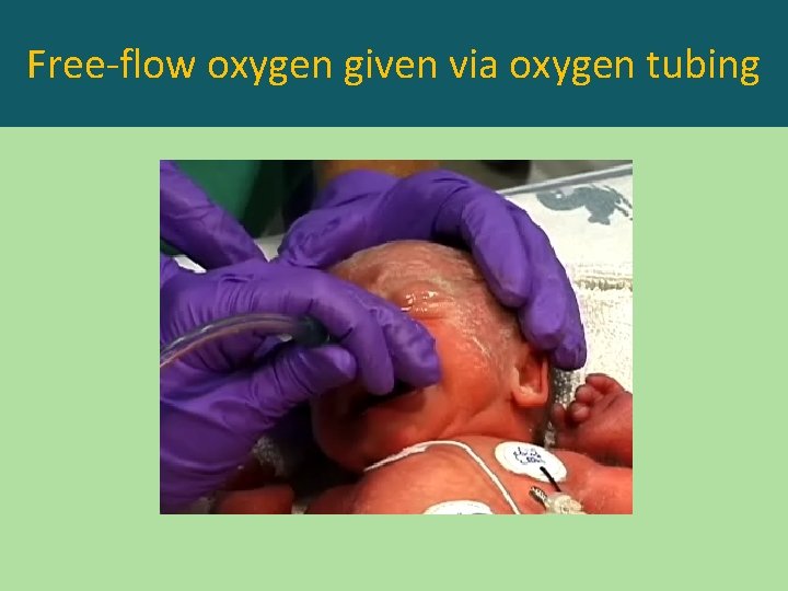 Free-flow oxygen given via oxygen tubing 