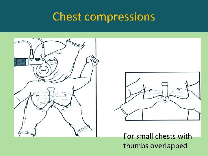 Chest compressions For small chests with thumbs overlapped 