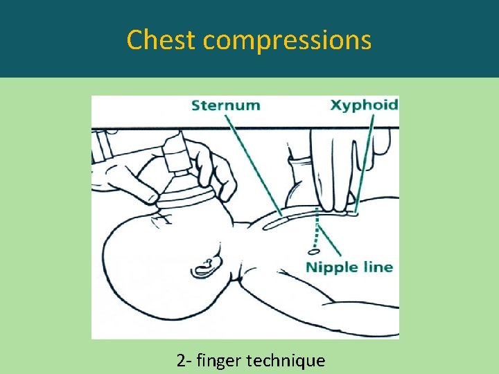 Chest compressions 2 - finger technique 