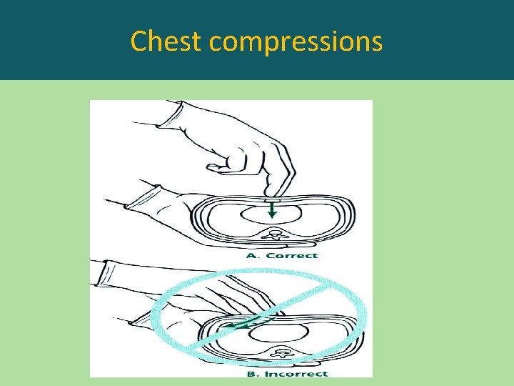 Chest compressions 