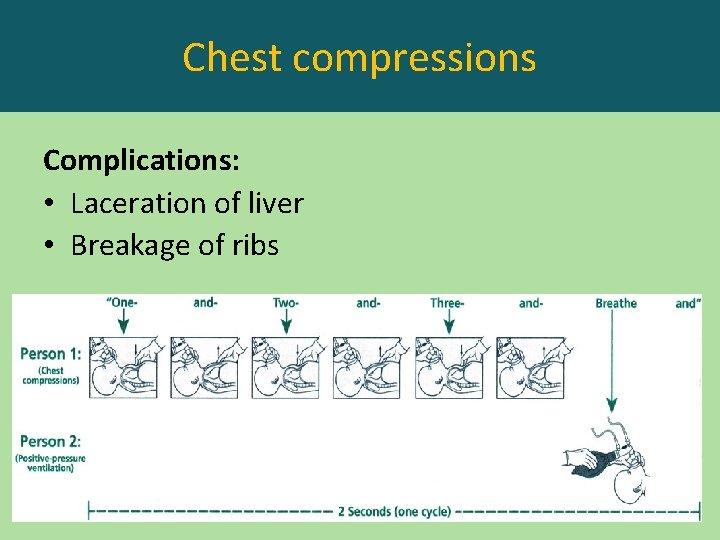 Chest compressions Complications: • Laceration of liver • Breakage of ribs 