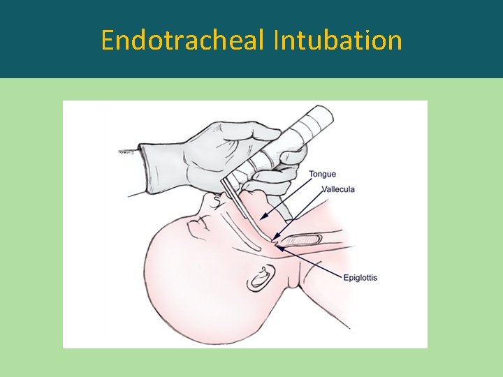 Endotracheal Intubation 