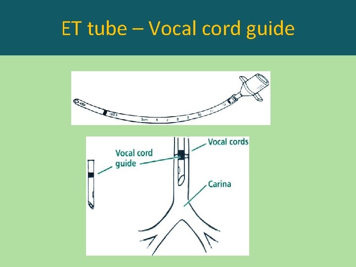 ET tube – Vocal cord guide 