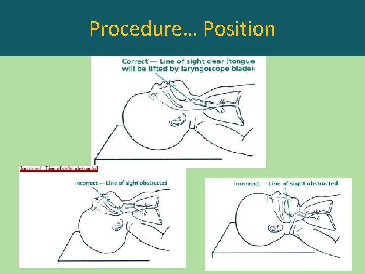 Procedure… Position 