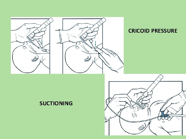 CRICOID PRESSURE SUCTIONING 