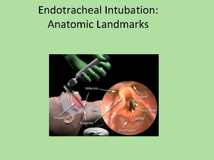 Endotracheal Intubation: Anatomic Landmarks 