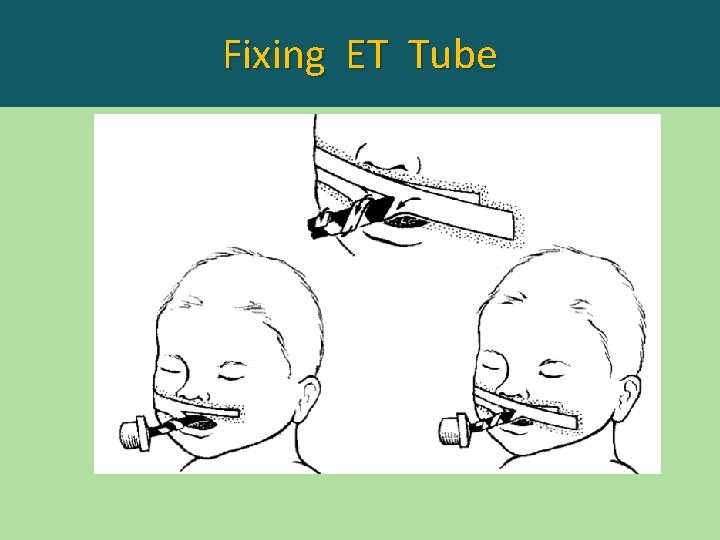 Fixing ET Tube 