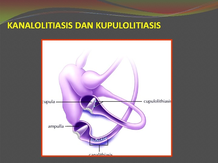 KANALOLITIASIS DAN KUPULOLITIASIS 