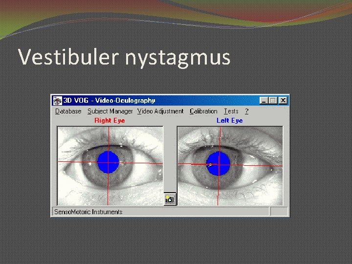 Vestibuler nystagmus 