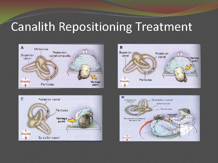 Canalith Repositioning Treatment 