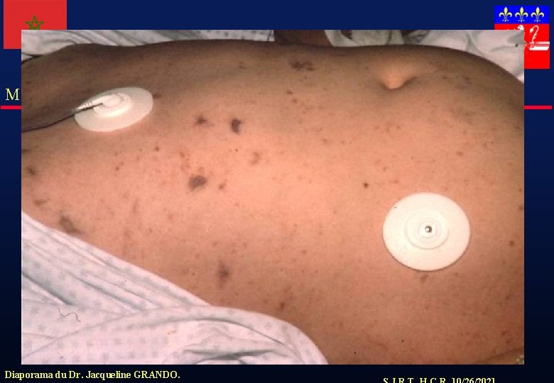 Meningocoque Diaporama du Dr. Jacqueline GRANDO. 