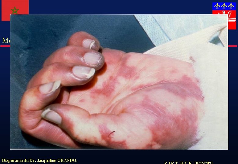 Meningocoque Diaporama du Dr. Jacqueline GRANDO. 