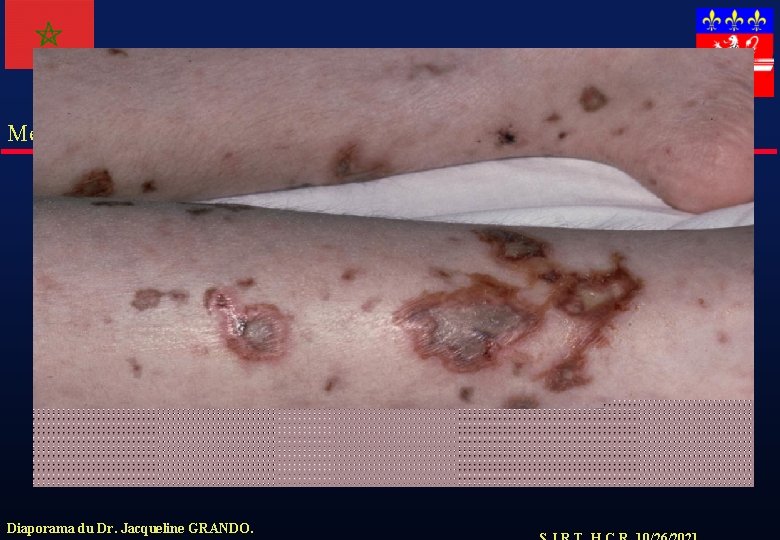 Meningocoque Diaporama du Dr. Jacqueline GRANDO. 