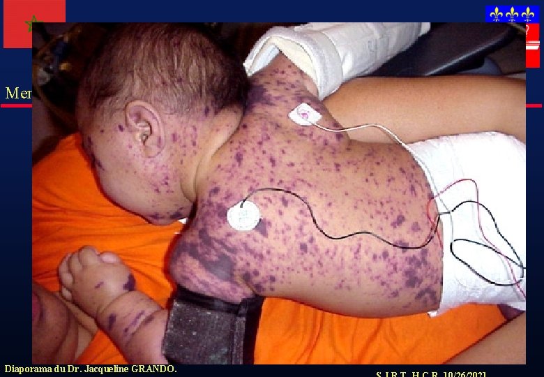 Meningocoque Diaporama du Dr. Jacqueline GRANDO. 