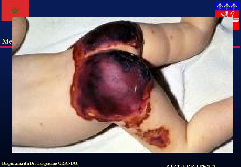 Meningocoque Diaporama du Dr. Jacqueline GRANDO. 