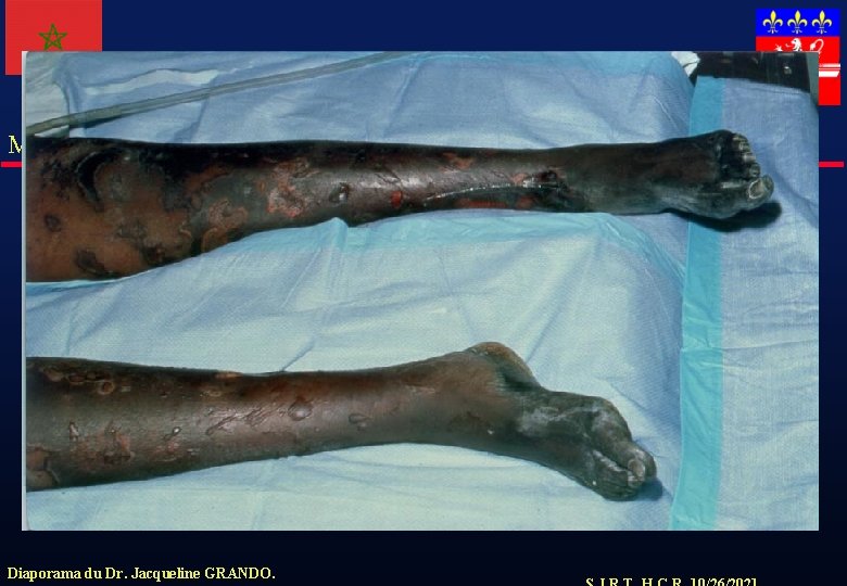 Meningocoque Diaporama du Dr. Jacqueline GRANDO. 