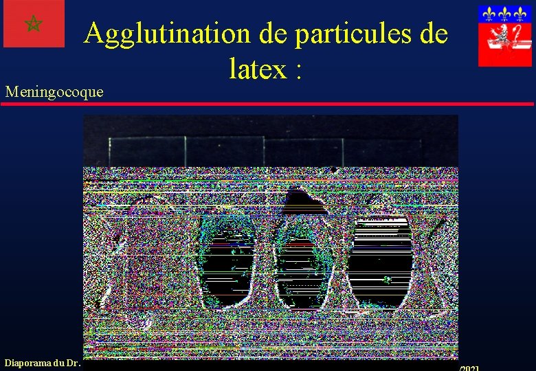 Agglutination de particules de latex : Meningocoque Diaporama du Dr. Jacqueline GRANDO. 
