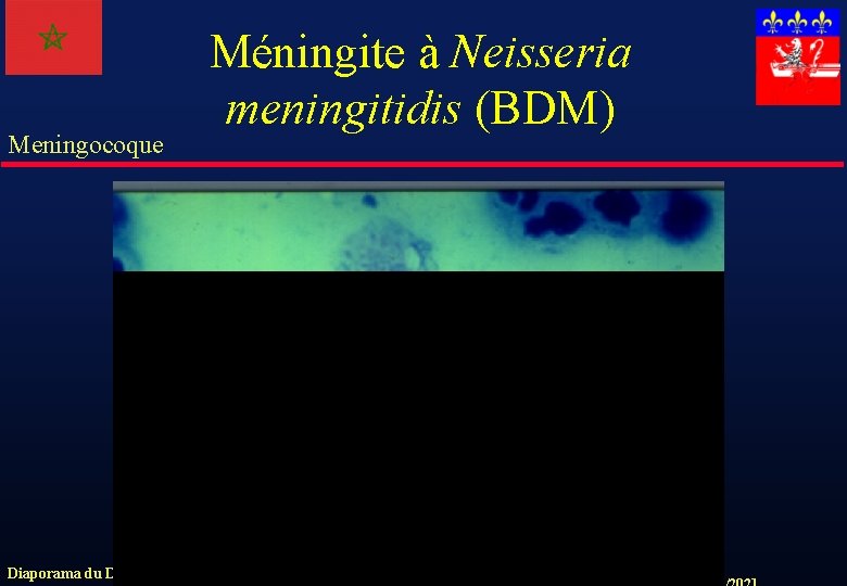 Meningocoque Méningite à Neisseria meningitidis (BDM) Diaporama du Dr. Jacqueline GRANDO. 
