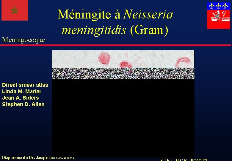 Meningocoque Méningite à Neisseria meningitidis (Gram) Direct smear atlas Linda M. Marler Jean A.