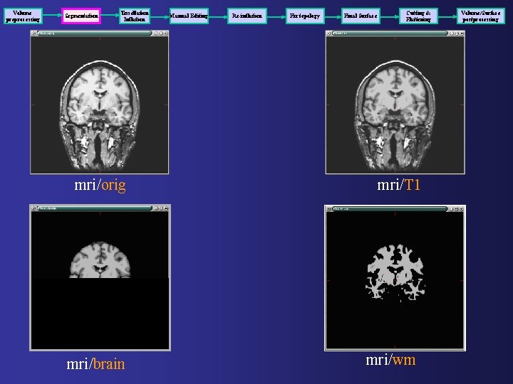 Volume preprocessing Segmentation Tessellation Inflation mri/orig mri/brain Manual Editing Re-inflation Fix topology Final Surface