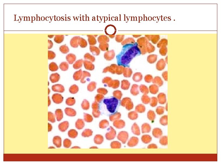 Lymphocytosis with atypical lymphocytes. 