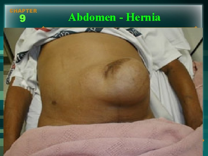 CHAPTER 9 Abdomen - Hernia 