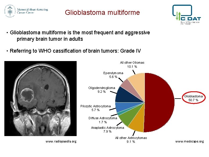 Glioblastoma multiforme • Glioblastoma multiforme is the most frequent and aggressive primary brain tumor