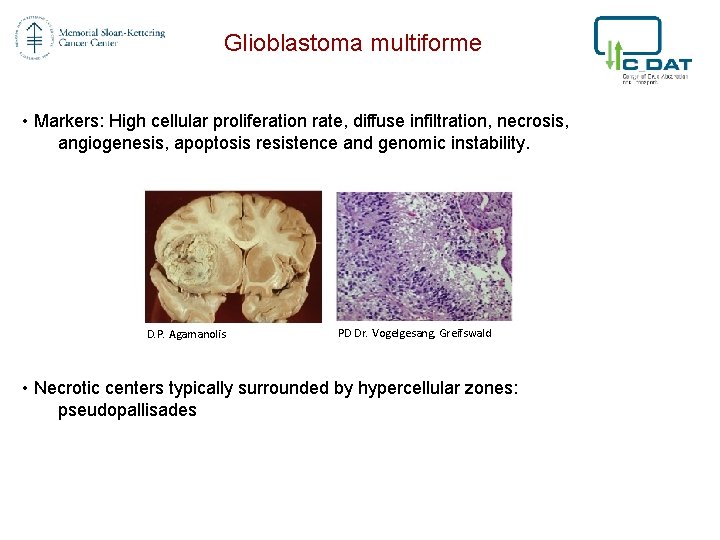 Glioblastoma multiforme • Markers: High cellular proliferation rate, diffuse infiltration, necrosis, angiogenesis, apoptosis resistence