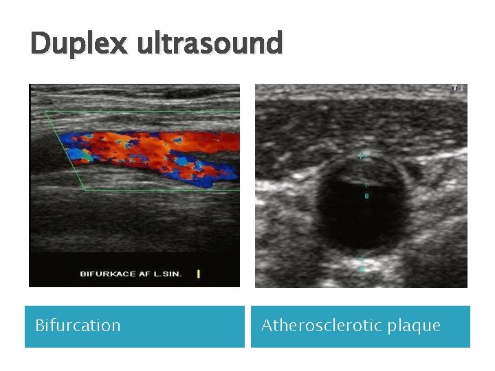 Duplex ultrasound Bifurcation Atherosclerotic plaque 
