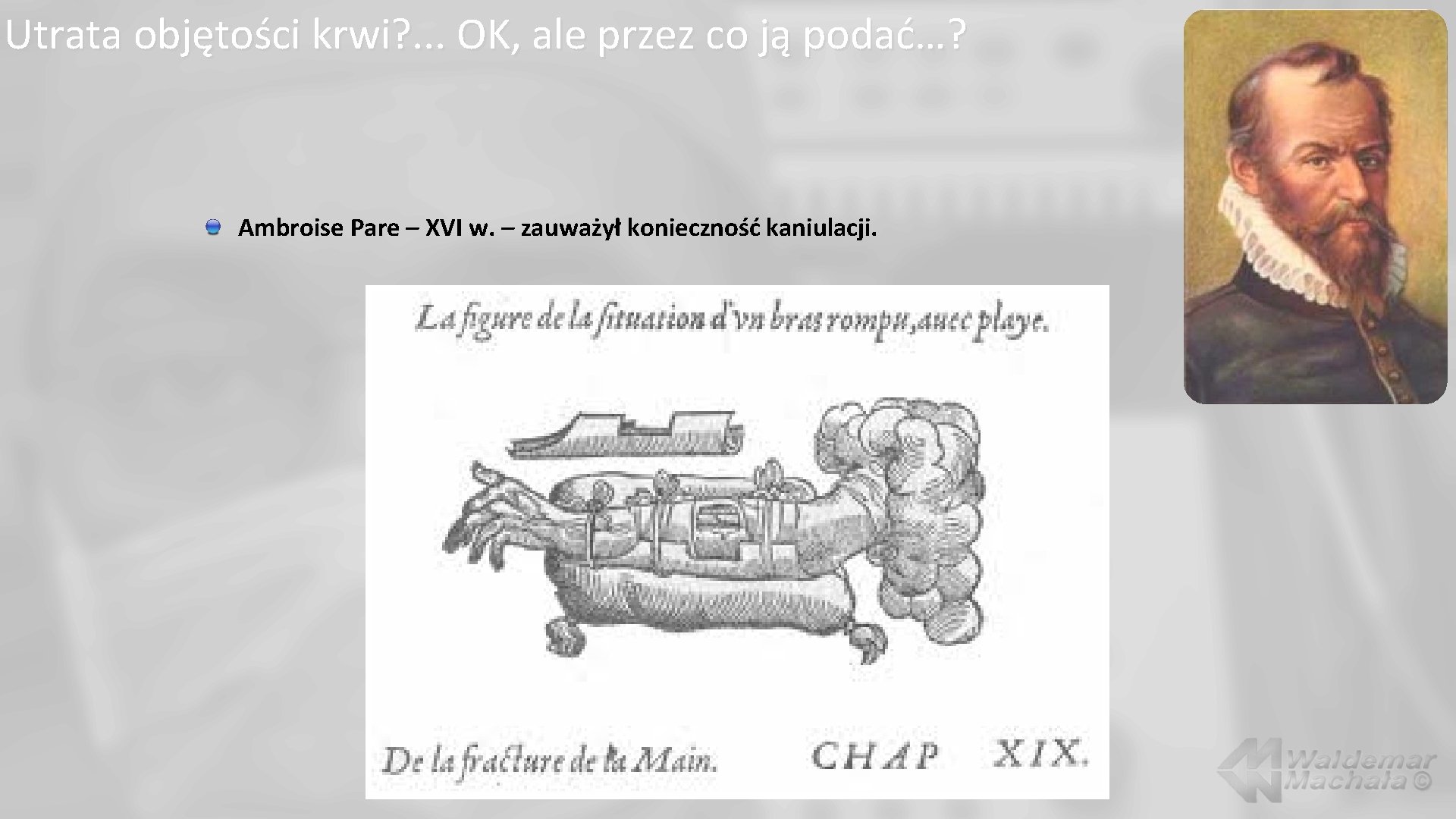 Utrata objętości krwi? . . . OK, ale przez co ją podać…? Ambroise Pare