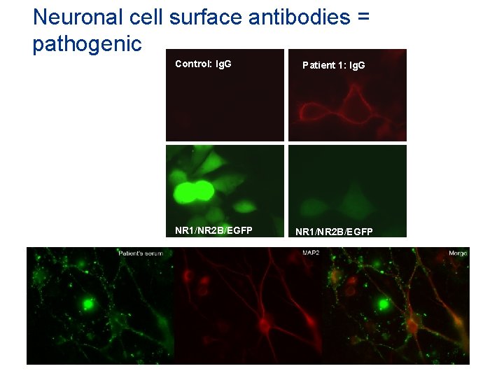Neuronal cell surface antibodies = pathogenic Control: Ig. G NR 1/NR 2 B/EGFP Patient