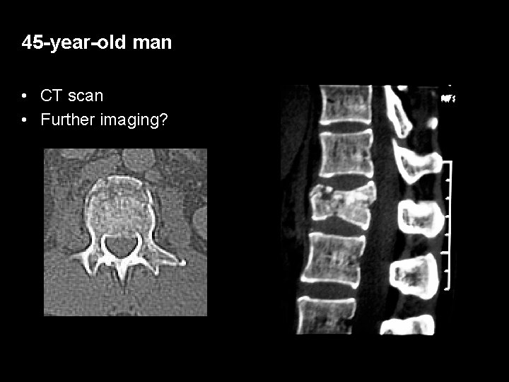 45 -year-old man • CT scan • Further imaging? 