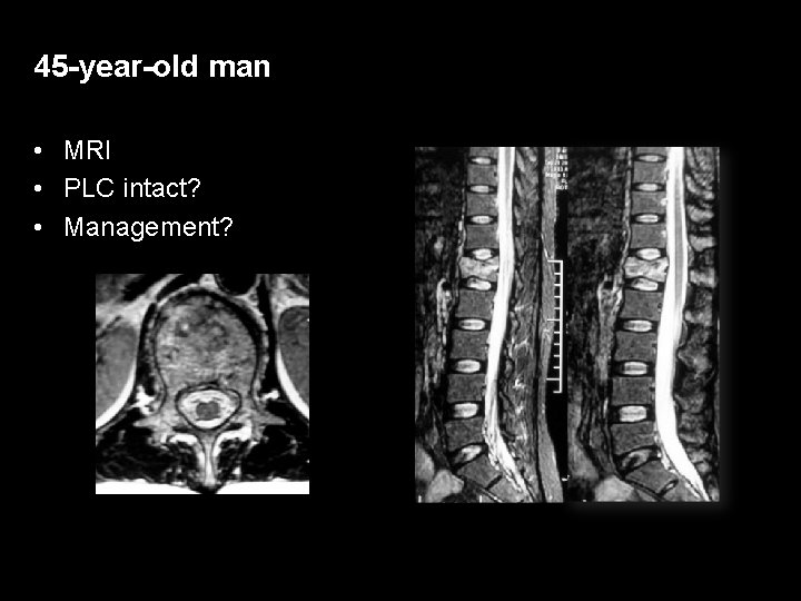 45 -year-old man • MRI • PLC intact? • Management? 