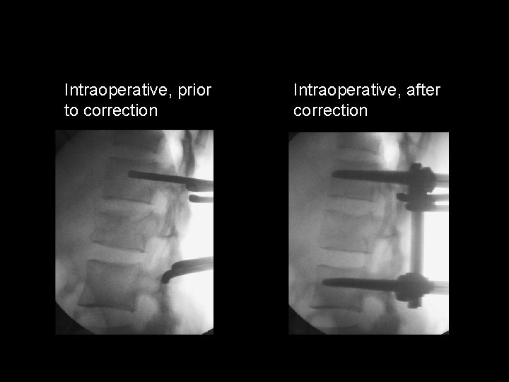 Intraoperative, prior to correction Intraoperative, after correction 