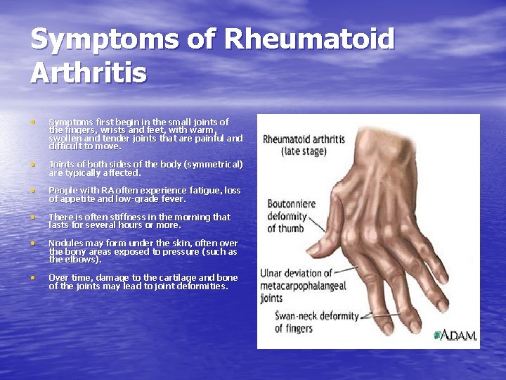 Symptoms of Rheumatoid Arthritis • Symptoms first begin in the small joints of the
