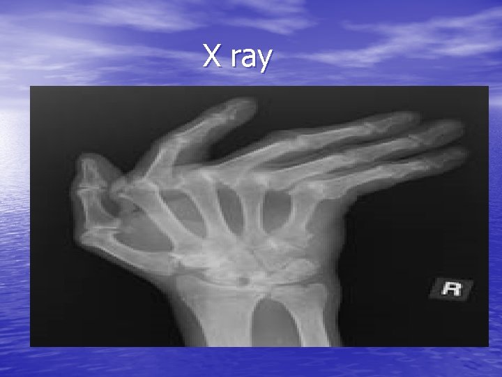 X ray 