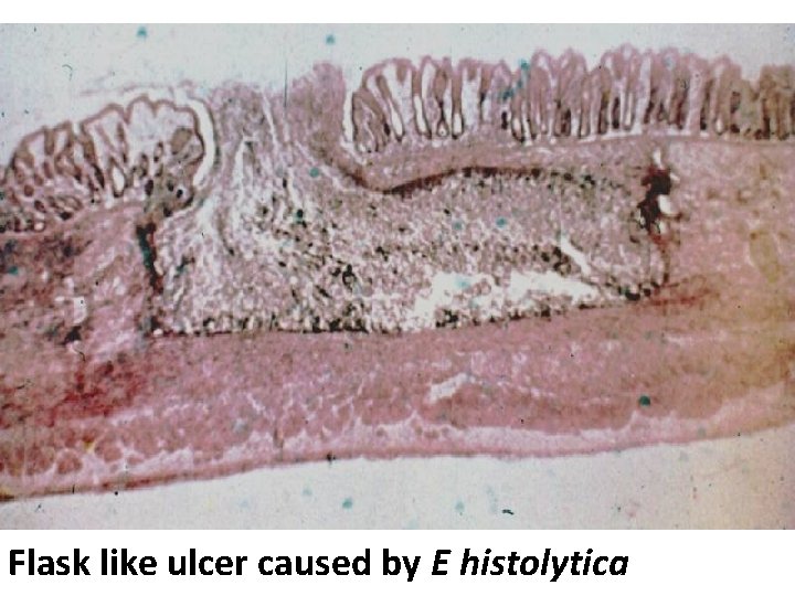 Flask like ulcer caused by E histolytica 