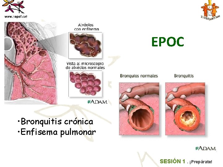 EPOC • Bronquitis crónica • Enfisema pulmonar SESIÓN 1. ¡Prepárate! 