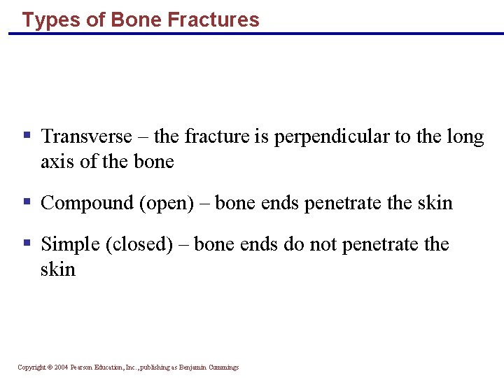 Types of Bone Fractures § Transverse – the fracture is perpendicular to the long