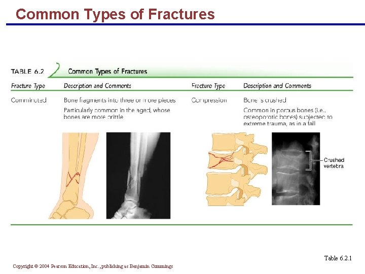 Common Types of Fractures Table 6. 2. 1 Copyright © 2004 Pearson Education, Inc.