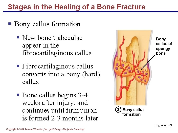 Stages in the Healing of a Bone Fracture § Bony callus formation § New