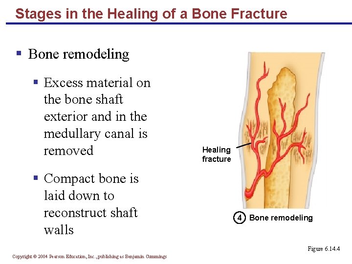 Stages in the Healing of a Bone Fracture § Bone remodeling § Excess material