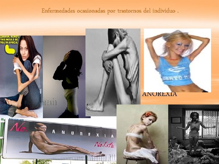 Enfermedades ocasionadas por trastornos del individuo. § ANOREXIA 