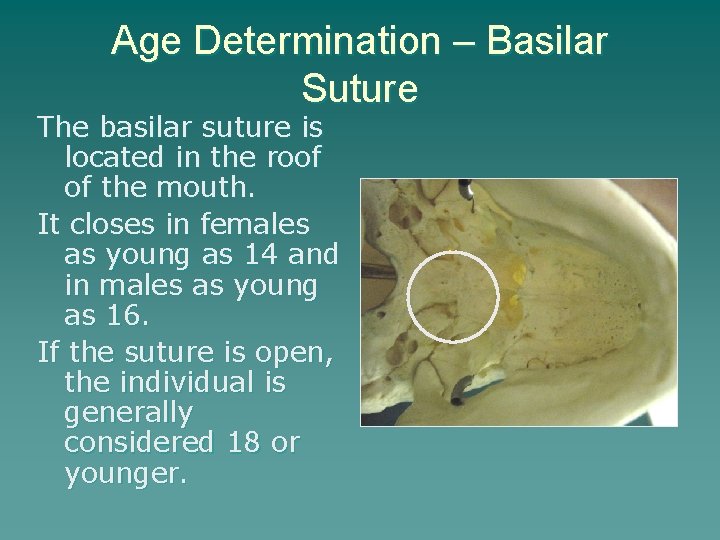 Age Determination – Basilar Suture The basilar suture is located in the roof of