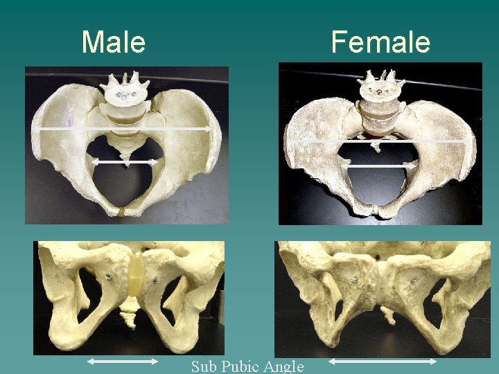 Male Female Sub Pubic Angle 