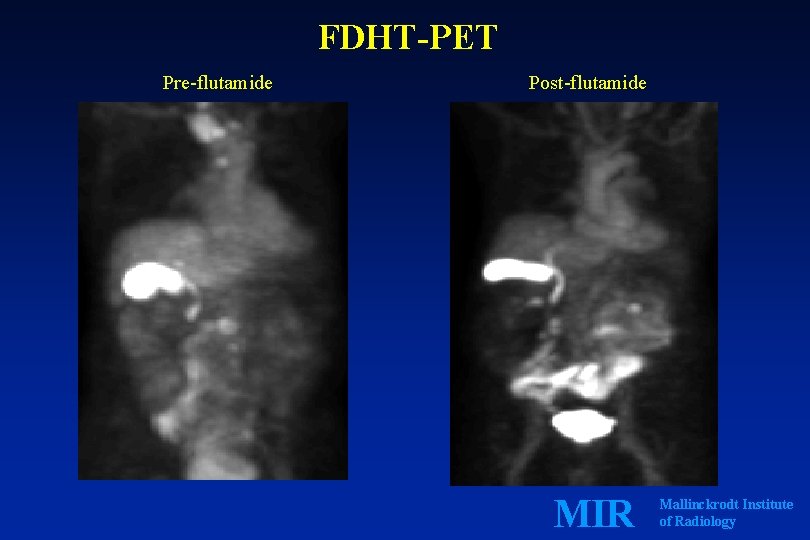 FDHT-PET Pre-flutamide Post-flutamide MIR Mallinckrodt Institute of Radiology 