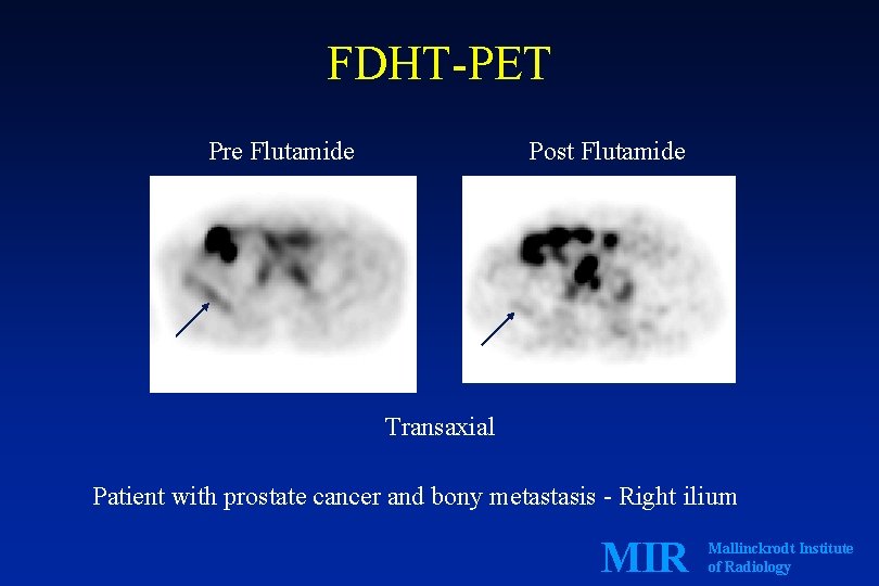 FDHT-PET Pre Flutamide Post Flutamide Transaxial Patient with prostate cancer and bony metastasis -